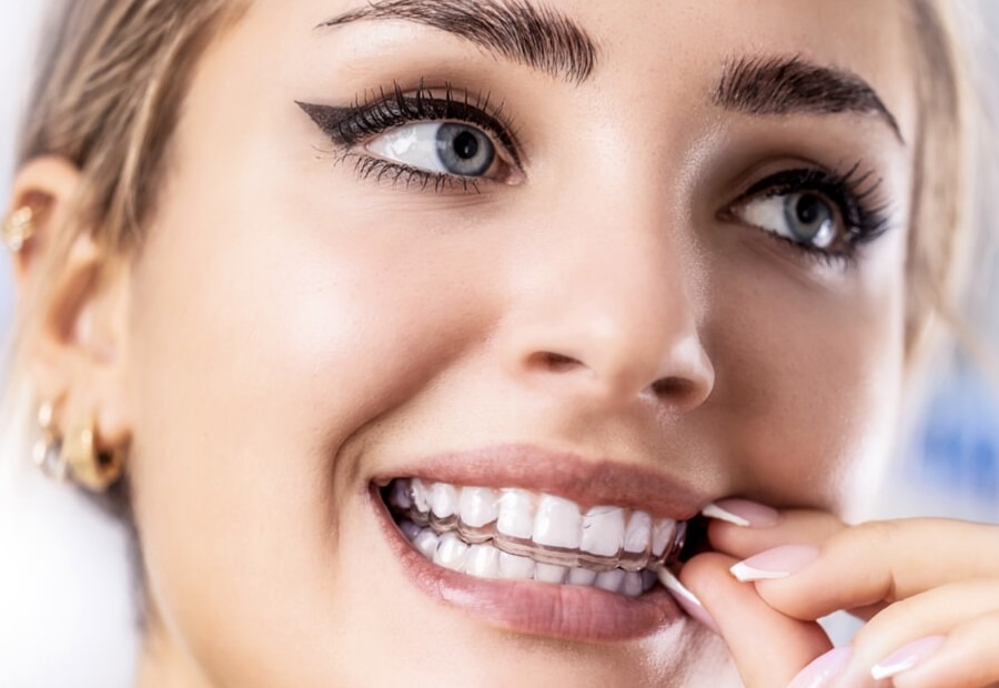 allineatori-ortodonzia-ortho.supply